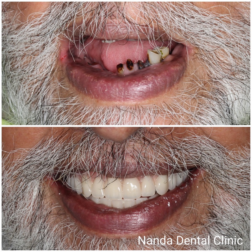 dental_implant11