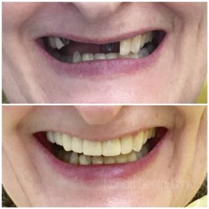 dental_implants6