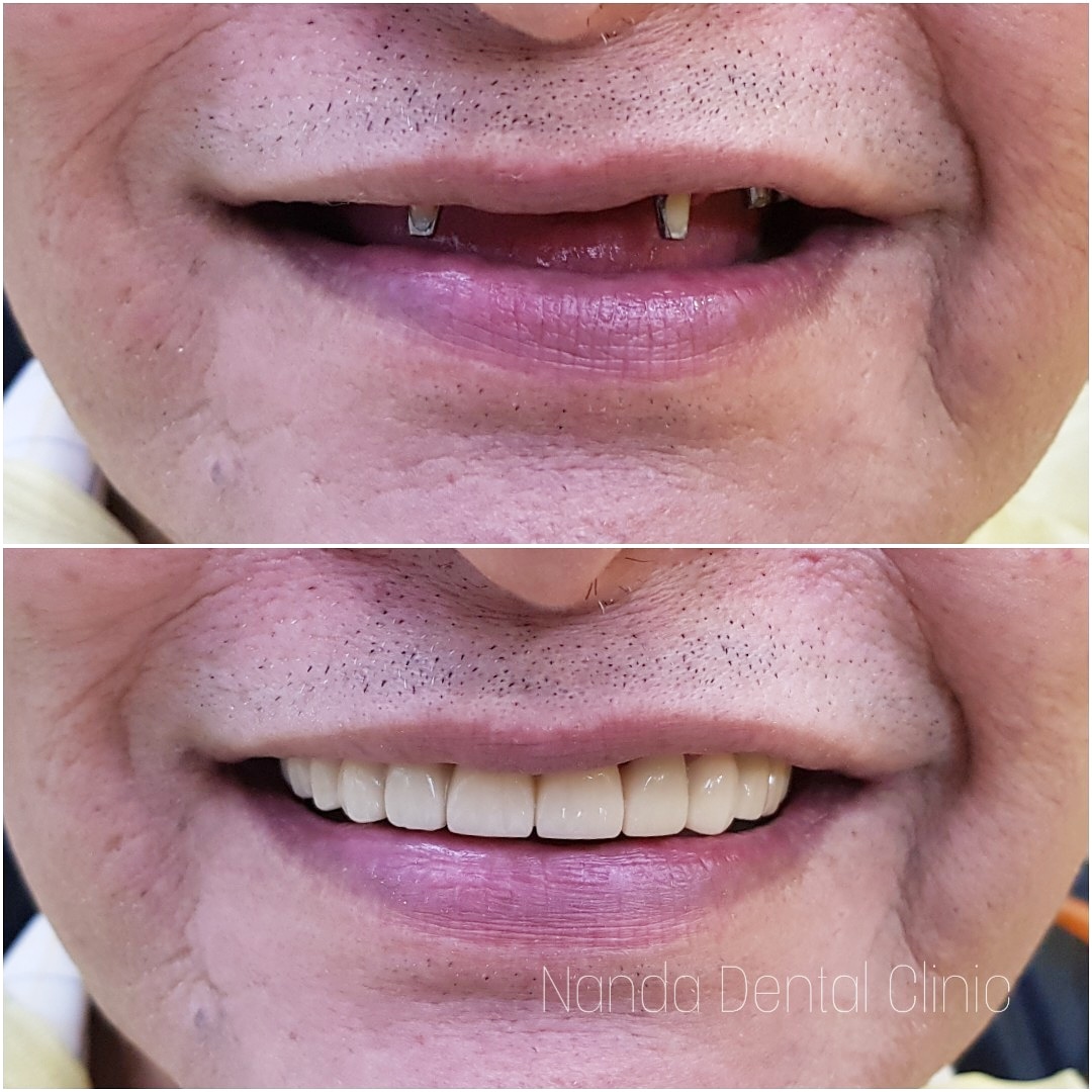 dental_implants7