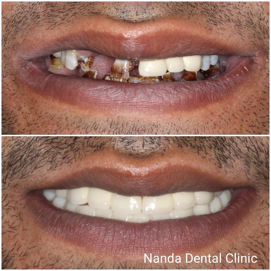 dental_implants9 (1)
