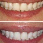 Before & After Invisalign Case