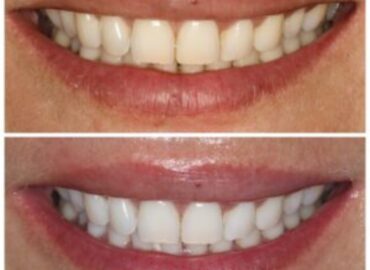 zoom-teeth-whitening-before-after-delhi