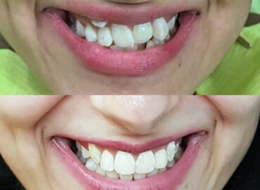 Before and after Invisalign treatment at Nanda Dental Clinic Delhi by Dr. Smriti Nanda