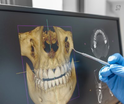 3D digital scan for Invisalign treatment at Nanda Dental Clinic Gurgaon