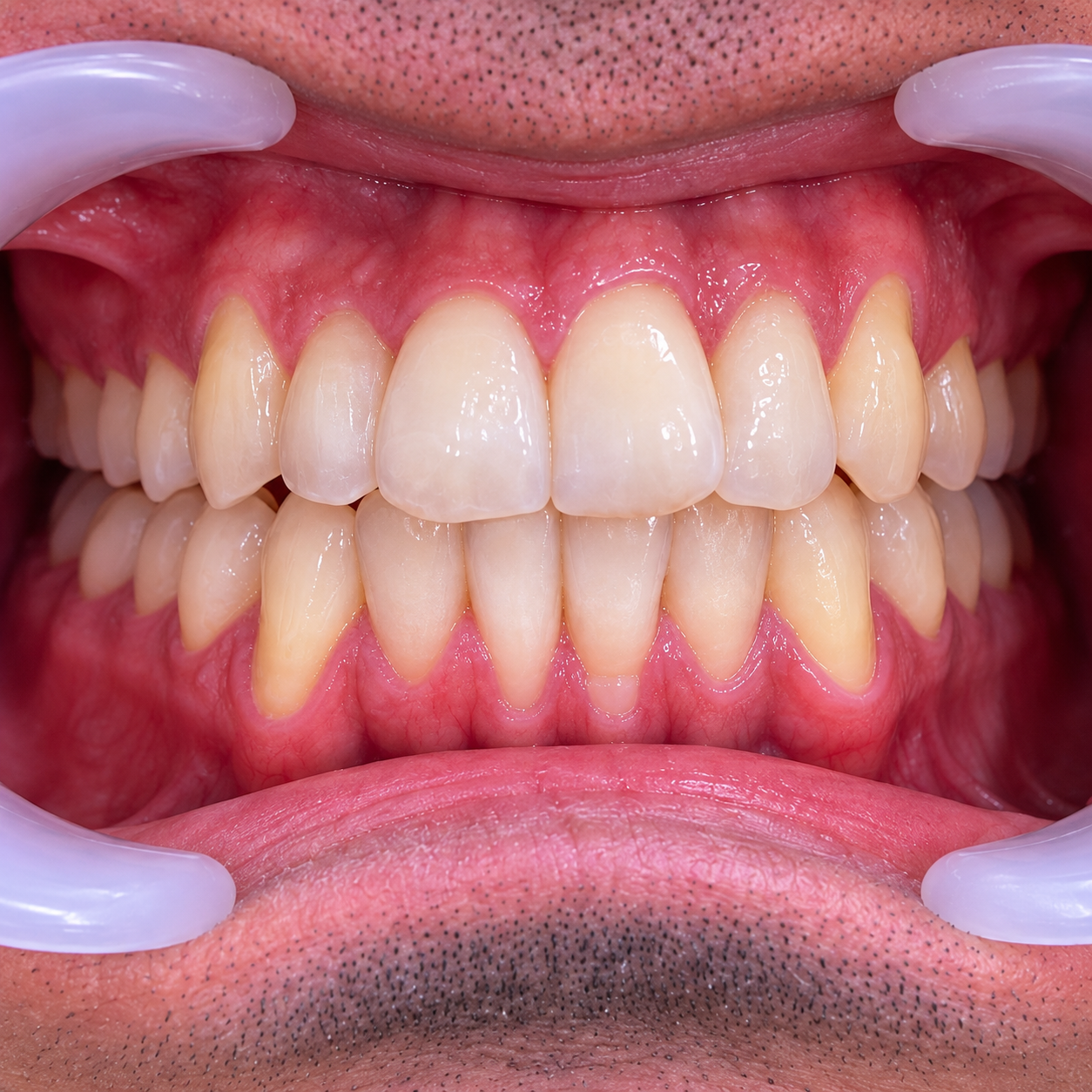 After Invisalign – Crowding