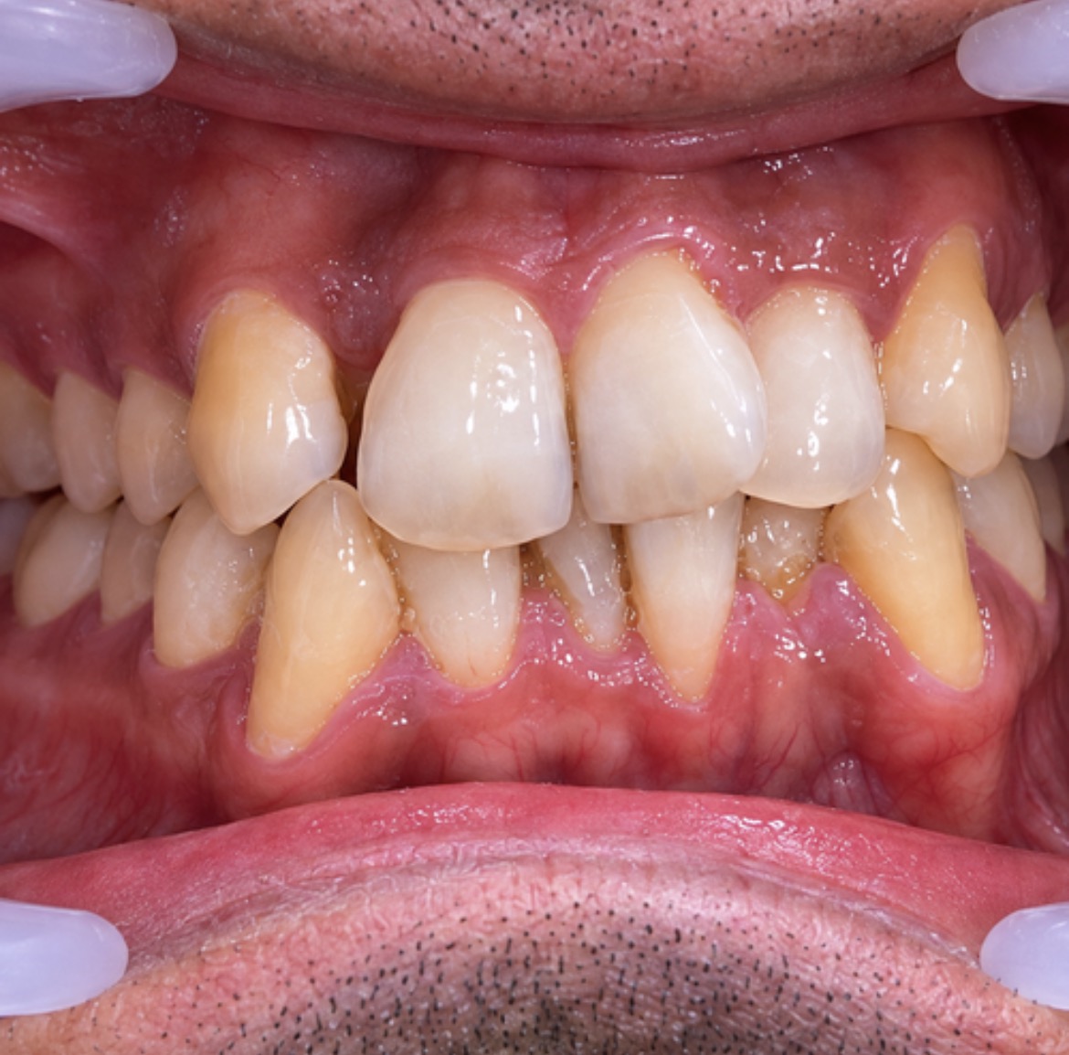 Before Invisalign – Crowding