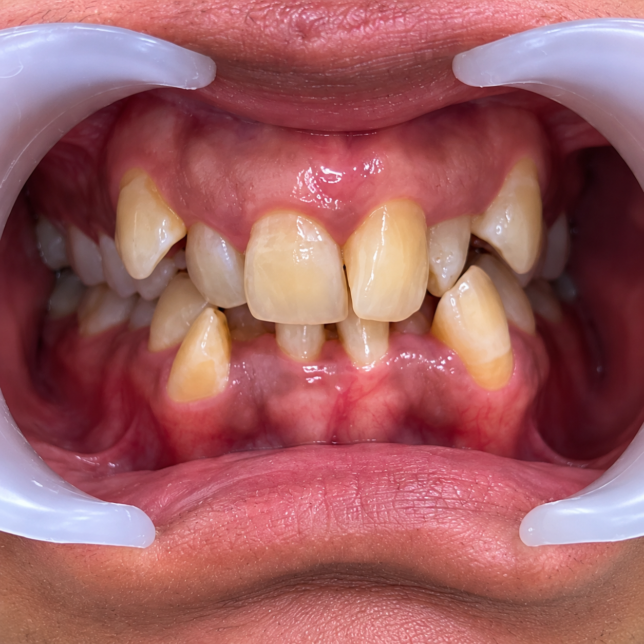 Before Invisalign – Gaps