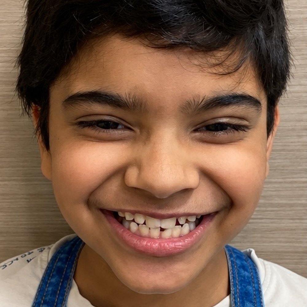 Before Invisalign – Invisalign