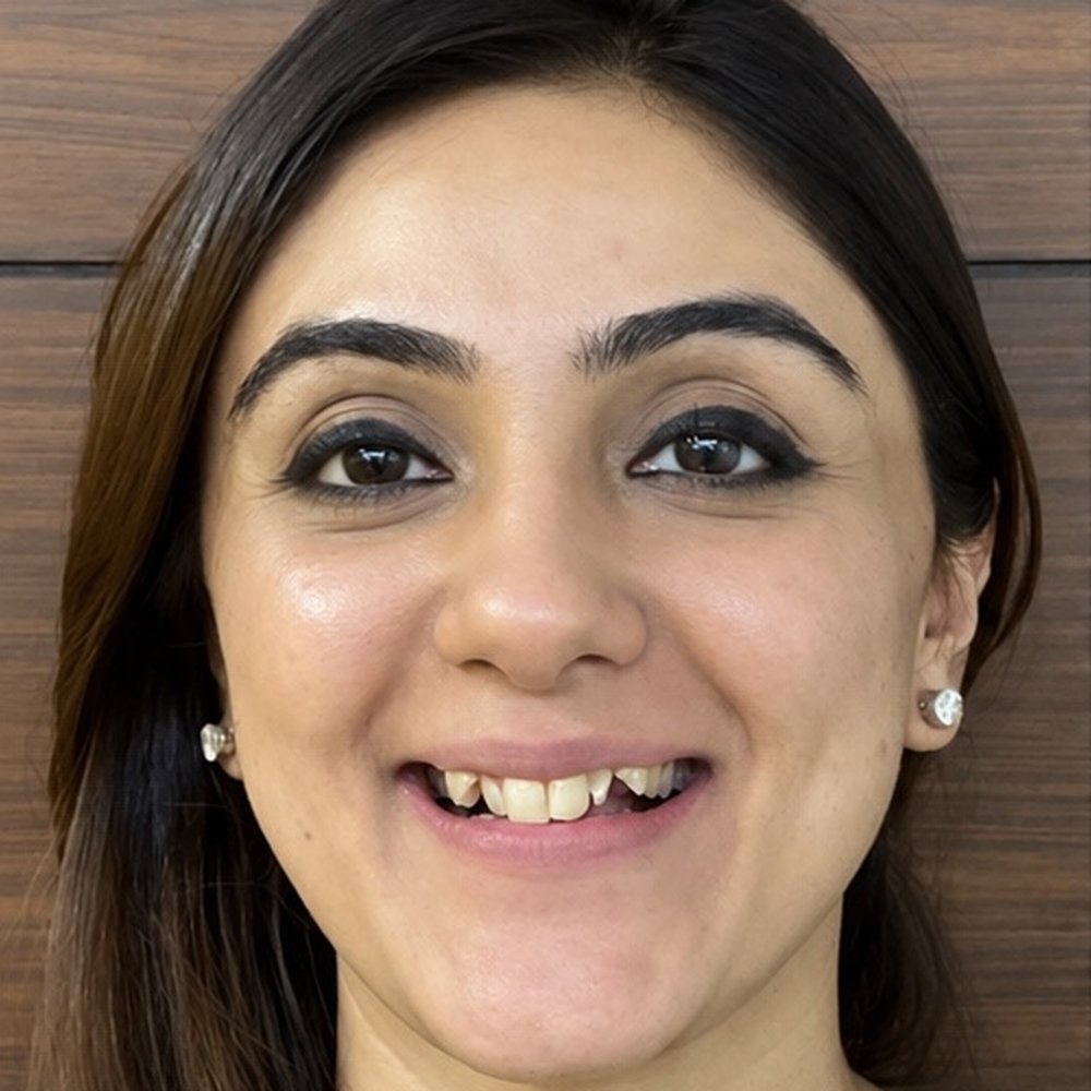 Before Invisalign – Invisalign